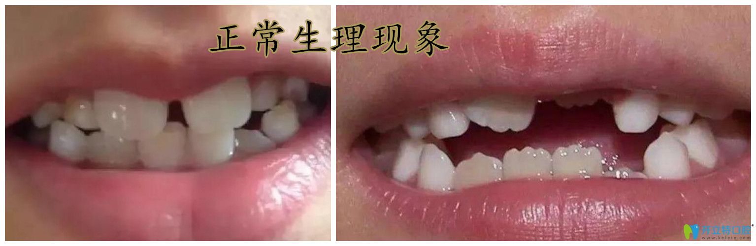 小孩新牙是锯齿牙正常吗 小孩新牙是锯齿牙正常吗