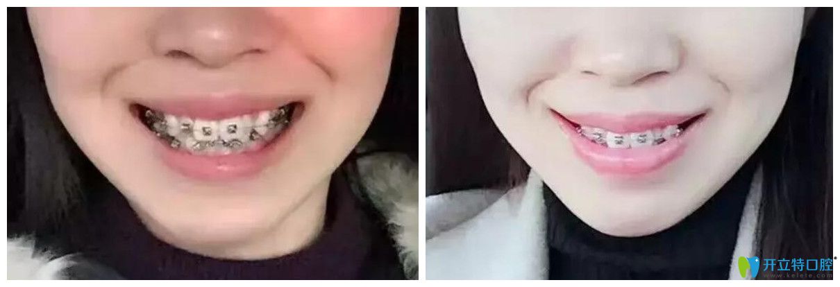 唐山北极星口腔牙齿矫正半年左右照片