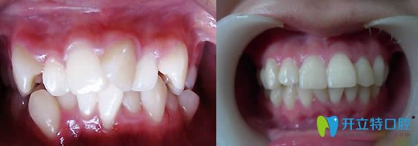 上海东奥齿科牙齿矫正案例效果对比图
