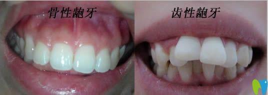 骨性龅牙和齿性龅牙症状图片