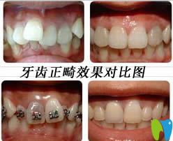 上海东奥口腔牙齿矫正前后效果对比图