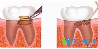 洗牙和龈下刮治可以一起做吗？看洗牙和刮治的区别在哪里
