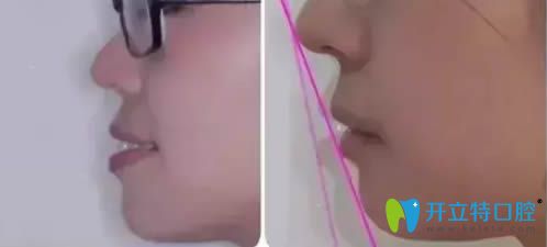 35岁顾客龅牙牙齿矫正案例对比图