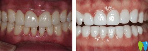 青岛维乐口腔瓷贴面前后对比图