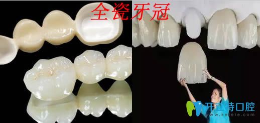 牙医都推荐二氧化锆全瓷牙的原因是什么
