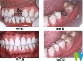 重庆牙博士种植牙效果对比图