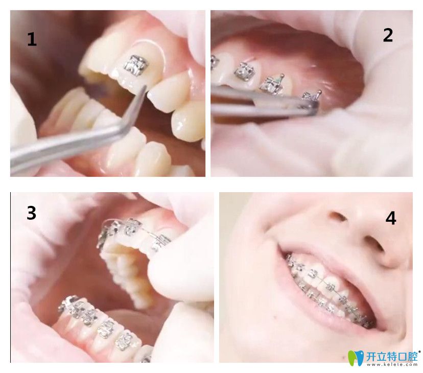 图解一下戴自锁金属托槽牙套的过程