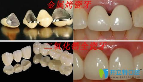 二氧化锆全瓷牙和金属烤瓷牙区别图片