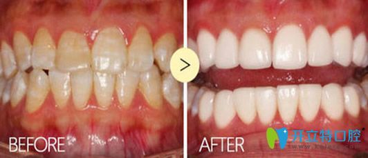 维乐口腔牙齿美白修复效果图