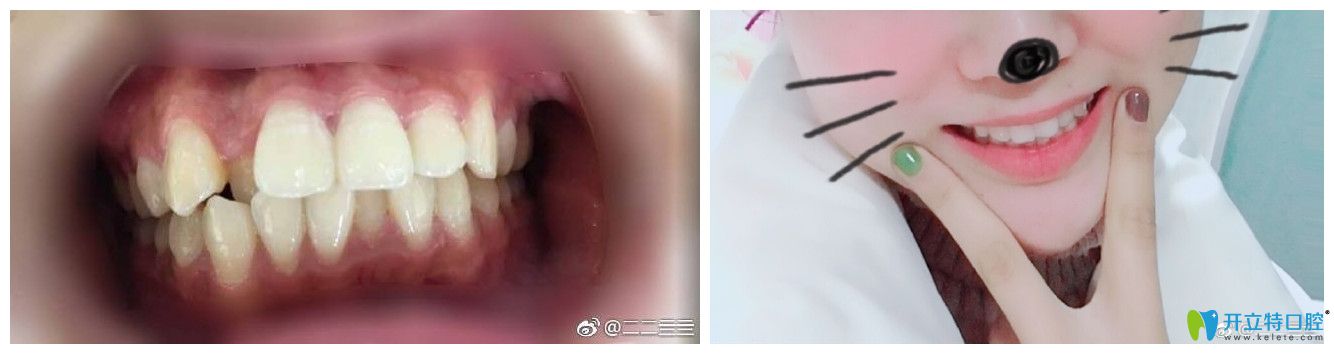 北京中诺口腔孙金鑫牙齿矫正好不好？案例效果来证明