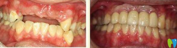 孙金鑫牙齿种植案例效果对比图