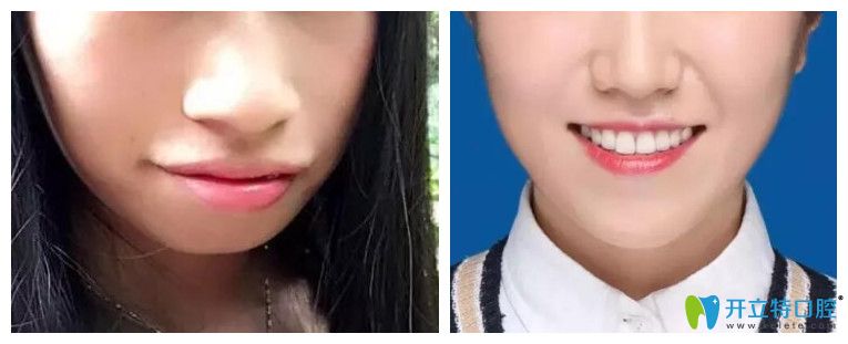 牙齿正畸对脸型的影响?看牙齿矫正案例效果前后对比图 牙齿正畸对脸型的影响?看牙齿矫正案例效果前后对比图