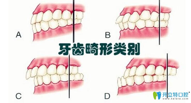 牙齿矫正为甚那么贵 牙齿矫正为甚那么贵