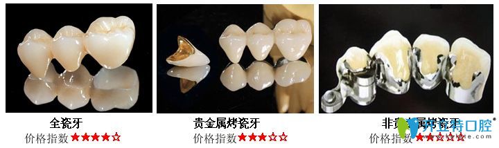 烤瓷牙的种类 烤瓷牙的种类