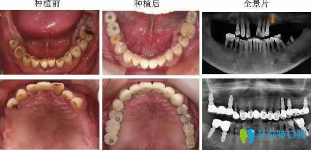 上海恒愿齿科即刻种植牙案例效果图