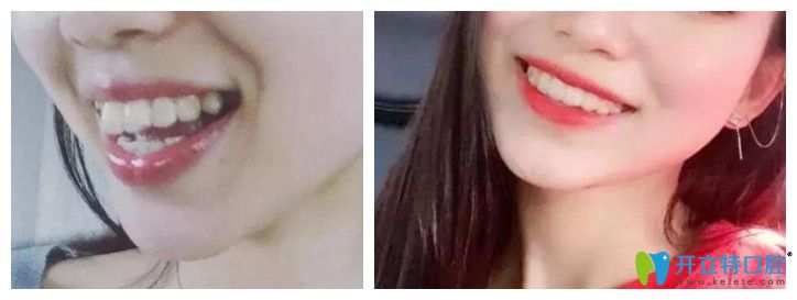 牙齿矫正能改变脸型吗？看维乐口腔<!--<i data=20240703-sp></i>-->龅牙矫正前后对比图