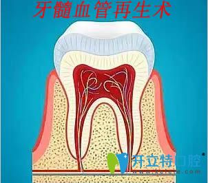什么是牙髓血管再生术？
