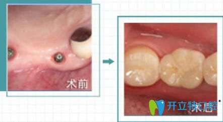 福州哪家种植牙好？维乐口腔陈献礼院长即刻种植案例来验证
