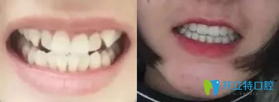 牙齿矫正前后对比图