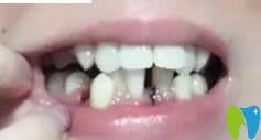 我在襄阳维乐口腔做牙齿矫正前照片