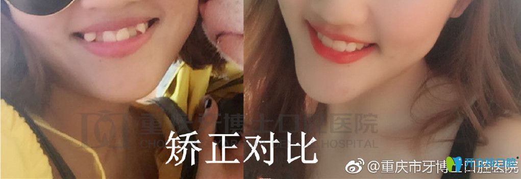 重庆牙博士正畸对比图