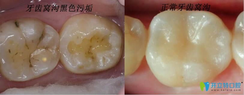 牙齿窝沟里的黑点蛀牙和正常磨牙对比图