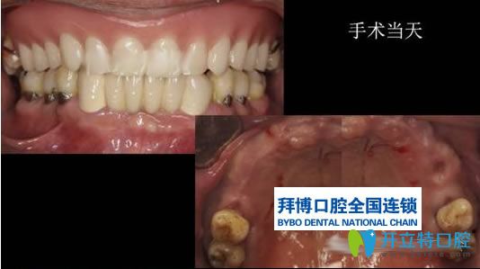 杨小林医生无牙颌种植病例前后对比效果