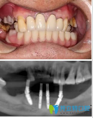 术后影像及半口即刻种植牙一年后照片