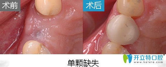 北京美莱口腔于英院长即刻种植牙案例