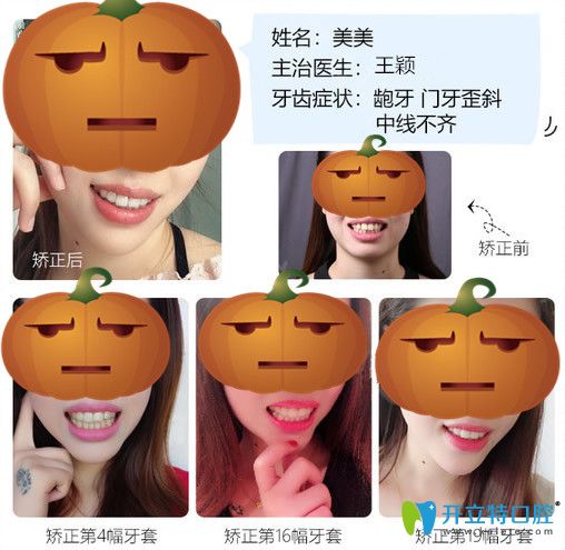 上海仁爱口腔牙齿矫正变化图