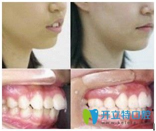北京美莱口腔宋学志主任龅牙矫正前后对比图