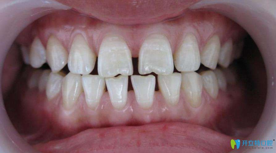 牙周炎医生不建议整牙是真的吗?谈牙周炎能不能做牙齿矫正