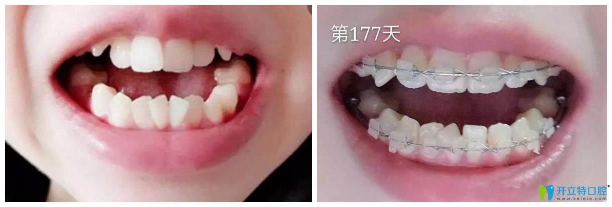 在汉中小白象口腔做牙齿矫正前和177天对比图牙齿矫正前和177天对比图片