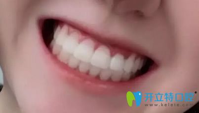 我在北京美莱口腔做隐形牙齿矫正500天牙套毕业