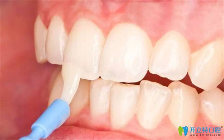 牙齿涂氟有副作用吗