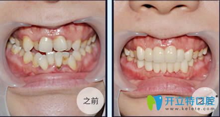 王海鑫医生3M牙齿托槽矫正14个月对比效果