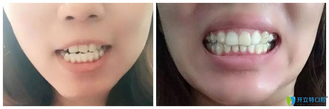 美莱口腔隐适美矫正牙齿案例对比图