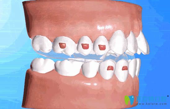 隐形牙套附件频繁掉落需要及时复诊处理