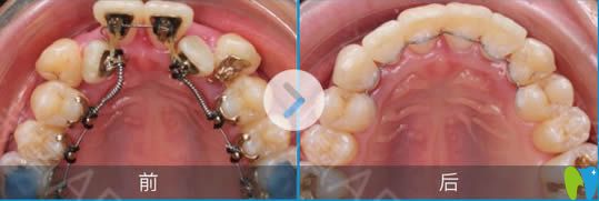 李真旼舌侧矫正案例及上颌牙矫正后前后对比效果