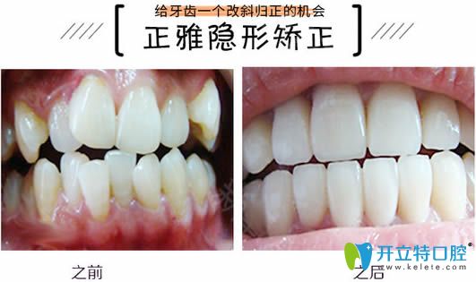 牙齿过度拥挤佩戴正雅矫正器13个月前后对比效果