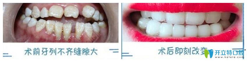 武汉爱思特口腔德国3D齿雕修复牙齿案例