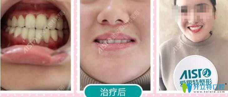 在武汉爱思特口腔做3D齿雕矫正牙齿案例照片