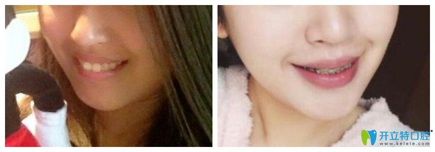 兔牙矫正牙齿会改变脸型吗?