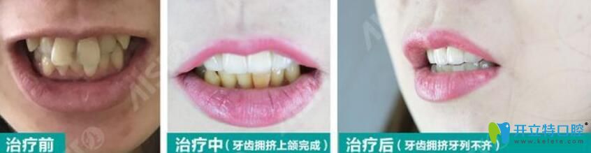明瑞芳德国3D齿雕修复牙齿过程案例展示