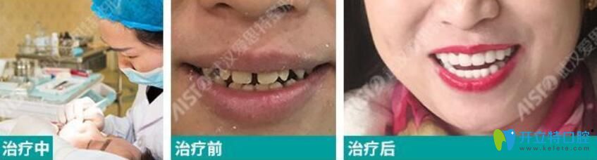 爱思特口腔采用3D齿雕技术矫正四环素牙的真人案例效果对比图
