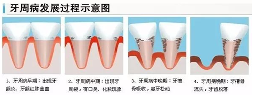 整牙会导致牙龈萎缩吗？整牙后牙龈萎缩怎么办？