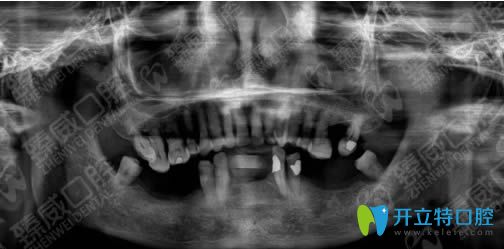 牙齿种植前口腔CT片