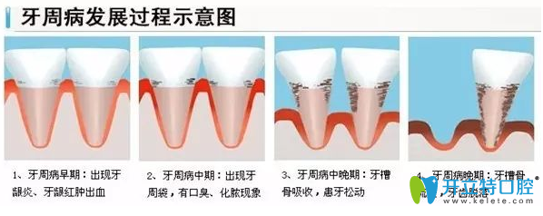 牙龈萎缩发展过程图