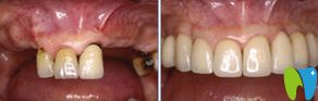 牙周炎做种植牙成功案例