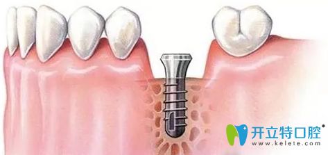 牙周炎对种植牙有哪些影响